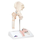 Femurfractuur en slijtage van het heupgewricht - Anatomie en pathologie